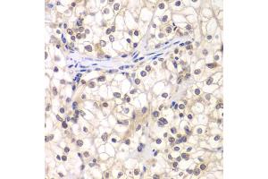 Immunohistochemistry of paraffin-embedded human kidney cancer using USF1 antibody. (USF1 antibody)