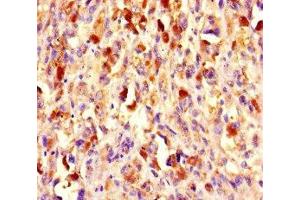 Immunohistochemistry of paraffin-embedded human melanoma using ABIN7147720 at dilution of 1:100 (CHD4 antibody  (AA 1-219))
