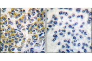 Immunohistochemistry analysis of paraffin-embedded human breast carcinoma tissue, using SHP-1 (Ab-536) Antibody.