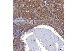 IHC analysis of PIG3/TP53I3 using anti-PIG3/TP53I3 antibody (ABIN7599280). (TP53I3 antibody  (AA 1-332))