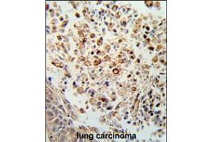 Formalin-fixed and paraffin-embedded human lung carcinoma reacted with FPRL2 Antibody , which was peroxidase-conjugated to the secondary antibody, followed by DAB staining. (FPR3 antibody  (AA 307-333))