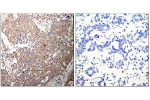 Immunohistochemical analysis of paraffin-embedded human breast carcinoma tissue using Keratin 18 (Ab-33) antibody (E021306). (Cytokeratin 18 antibody)