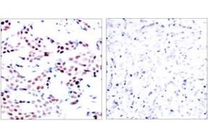 Immunohistochemistry analysis of paraffin-embedded human breast carcinoma, using c-Jun (Phospho-Thr91) Antibody.