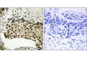 Immunohistochemistry analysis of paraffin-embedded human breast carcinoma, using MSK1 (Phospho-Ser212) Antibody. (MSK1 antibody  (pSer212))
