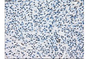 Immunohistochemical staining of paraffin-embedded Adenocarcinoma of colon tissue using anti-ZFP36 mouse monoclonal antibody. (ZFP36 antibody)