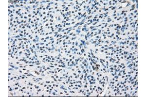 Immunohistochemical staining of paraffin-embedded Adenocarcinoma of colon tissue using anti-ZFP36 mouse monoclonal antibody. (ZFP36 antibody)