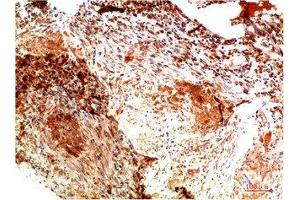 Immunohistochemical analysis of paraffin-embedded Human Lung Carcinoma Tissue using Collagen II Mouse mAb diluted at 1:200. (COL2A1 antibody)