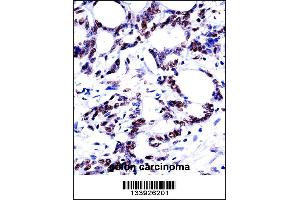 HNRNPM Antibody immunohistochemistry analysis in formalin fixed and paraffin embedded human colon carcinoma followed by peroxidase conjugation of the secondary antibody and DAB staining. (HNRNPM antibody  (N-Term))