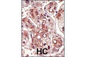 Formalin-fixed and paraffin-embedded human cancer tissue reacted with the primary antibody, which was peroxidase-conjugated to the secondary antibody, followed by DAB staining. (MEK2 antibody  (AA 262-292))