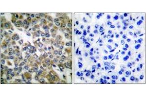 Immunohistochemistry analysis of paraffin-embedded human breast carcinoma tissue, using Keratin 14 Antibody. (KRT14 antibody  (AA 1-50))