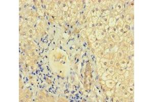 Immunohistochemistry of paraffin-embedded human liver cancer using ABIN7157448 at dilution of 1:100 (Keratin 71 antibody  (AA 201-500))