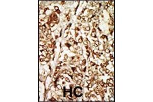 Formalin-fixed and paraffin-embedded human cancer tissue reacted with the primary antibody, which was peroxidase-conjugated to the secondary antibody, followed by AEC staining. (MOS antibody  (N-Term))