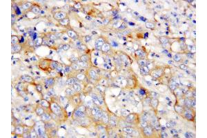 Anti-PF4 antibody, IHC(P) IHC(P): Human Lung Cancer Tissue (PF4 antibody  (C-Term))