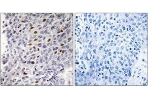Immunohistochemistry analysis of paraffin-embedded human lung carcinoma tissue, using ATF1 (Ab-63) Antibody. (AFT1 antibody  (AA 31-80))