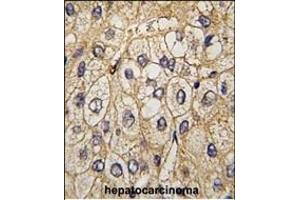 Formalin-fixed and paraffin-embedded human hepatocarcinoma tissue reacted with EphA7 antibody (ABIN391900 and ABIN2841718) , which was peroxidase-conjugated to the secondary antibody, followed by DAB staining. (EPH Receptor A7 antibody)