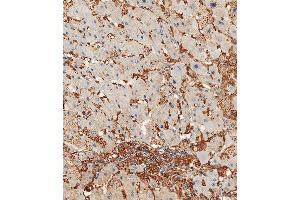 Immunohistochemical analysis of paraffin-embedded Human hepatocarcinoma tissue using A performed on the Leica® BOND RXm.