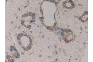Detection of ICAM2 in Human Bile duct cancer Tissue using Polyclonal Antibody to Intercellular Adhesion Molecule 2 (ICAM2) (ICAM2 antibody  (AA 34-241))