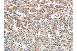 The image on the left is immunohistochemistry of paraffin-embedded Human liver cancer tissue using ABIN7131474(TRIM16 Antibody) at dilution 1/35, on the right is treated with fusion protein. (TRIM16 antibody)