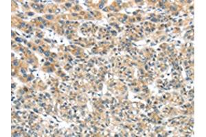 The image on the left is immunohistochemistry of paraffin-embedded Human liver cancer tissue using ABIN7131474(TRIM16 Antibody) at dilution 1/35, on the right is treated with fusion protein.