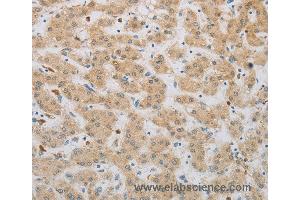 Immunohistochemistry of Human gastric cancer using NBN Polyclonal Antibody at dilution of 1:50 (Nibrin antibody)