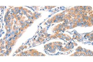 Immunohistochemistry of paraffin-embedded Human breast cancer using CD297 Polyclonal Antibody at dilution of 1:30 (ART4 antibody)