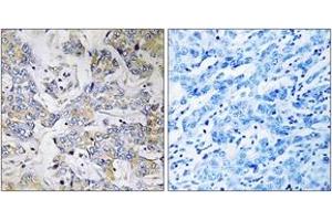 Immunohistochemistry analysis of paraffin-embedded human breast carcinoma tissue, using RPL37 Antibody.