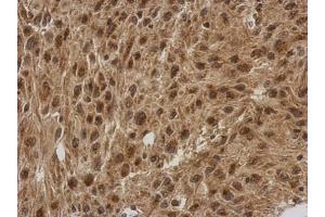 IHC-P Image Immunohistochemical analysis of paraffin-embedded U373 xenograft, using FGF13, antibody at 1:500 dilution. (FGF13 antibody)