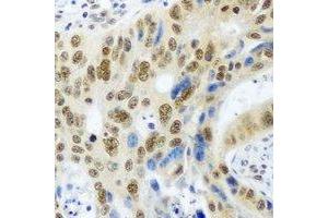 Immunohistochemical analysis of PSMA4 staining in human colon cancer formalin fixed paraffin embedded tissue section. (PSMA4 antibody)