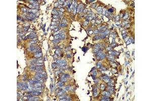 Immunohistochemistry of paraffin-embedded Human colon carcinoma using QARS Polyclonal Antibody at dilution of 1:100 (40x lens).