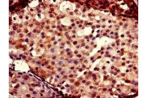 Immunohistochemistry of paraffin-embedded human breast cancer using ABIN7153026 at dilution of 1:100 (FOXC2 antibody  (AA 24-294))