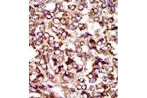 Formalin-fixed and paraffin-embedded human cancer tissue reacted with the primary antibody, which was peroxidase-conjugated to the secondary antibody, followed by DAB staining. (CDK2 antibody  (C-Term))