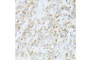 Immunohistochemistry of paraffin-embedded human lung cancer using EGFR antibody (ABIN6133679, ABIN6139975, ABIN6139980 and ABIN6215265) at dilution of 1:100 (40x lens). (EGFR antibody  (AA 960-1060))