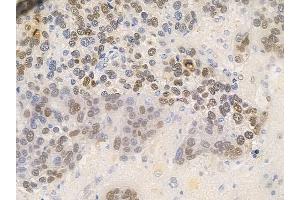 ABIN6256479 and ABIN6267655 at 1/100 staining human glioblastoma by IHC-P.