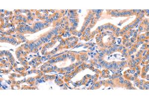 Immunohistochemistry of paraffin-embedded Human thyroid cancer tissue using AP1B1 Polyclonal Antibody at dilution 1:70