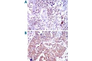 Immunohistochemical analysis of paraffin-embedded human intima cancer tissues (A) and human bladder cancer tissues (B) using NFKB1 monoclonal antibody, clone 5D10D11  with DAB staining.