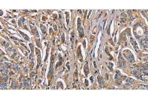 Immunohistochemistry of paraffin-embedded Human prostate cancer tissue using ABI3BP Polyclonal Antibody at dilution 1:60 (ABI3BP antibody)