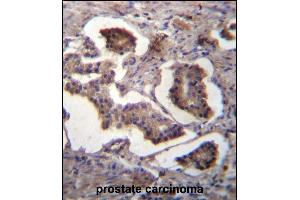 GUF1 Antibody (N-term) (ABIN656785 and ABIN2846003) immunohistochemistry analysis in formalin fixed and paraffin embedded human prostate carcinoma followed by peroxidase conjugation of the secondary antibody and DAB staining. (GUF1 antibody  (N-Term))