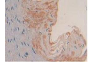 IHC-P analysis of Human Esophagus Cancer Tissue, with DAB staining. (SYK antibody  (AA 374-635))