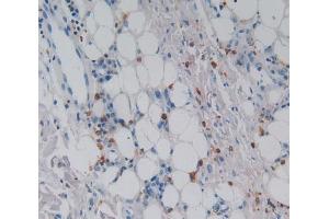 Used in DAB staining on fromalin fixed paraffin- embedded skin cancer tissue (CSF2RA antibody  (AA 28-112))