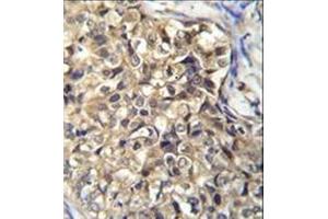 Immunohistochemistry analysis in formalin fixed and paraffin embedded human breast carcinoma reacted with KLHL35 Antibody (C-term) followed by peroxidase conjugation of the secondary antibody and DAB staining. (KLHL35 antibody  (C-Term))