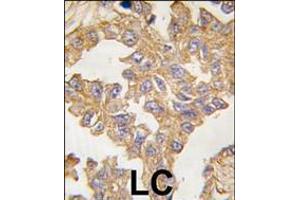Formalin-fixed and paraffin-embedded human lung carcinoma tissue reacted with ACTB/ACTC antibody , which was peroxidase-conjugated to the secondary antibody, followed by DAB staining. (Actin antibody  (N-Term))