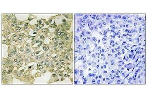 Immunohistochemical analysis of paraffin-embedded human breast carcinoma tissue using MYT1 (Phospho-Ser83) antibody (left)or the same antibody preincubated with blocking peptide (right). (PKMYT1 antibody  (pSer83))