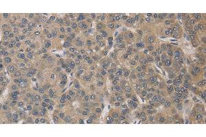 Immunohistochemistry of paraffin-embedded Human liver cancer tissue using ELOVL1 Polyclonal Antibody at dilution 1:30 (ELOVL1 antibody)