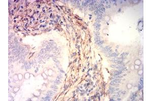 Immunohistochemical analysis of paraffin-embedded rectum cancer tissues using CNN3 mouse mAb with DAB staining. (CNN3 antibody  (AA 26-130))