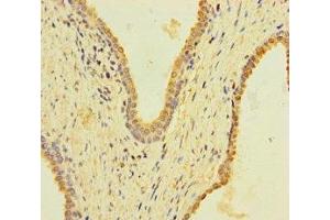 Immunohistochemistry of paraffin-embedded human prostate cancer using ABIN7157404 at dilution of 1:100 (KRT4 antibody  (AA 1-200))