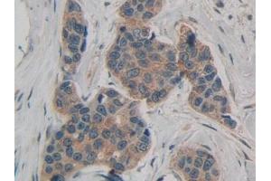 Detection of ATXN1 in Human Breast cancer Tissue using Polyclonal Antibody to Ataxin 1 (ATXN1) (Ataxin 1 antibody  (AA 569-807))