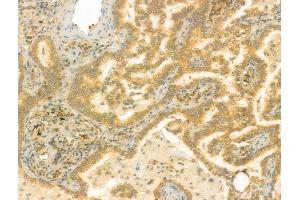 ABIN6259338 and ABIN6275436 at 1/100 staining Human lung cancer by IHC-P.