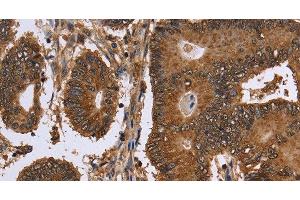 Immunohistochemistry of paraffin-embedded Human colon cancer tissue using FANCF Polyclonal Antibody at dilution 1:60 (FANCF antibody)