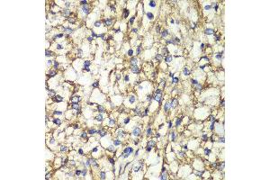 Immunohistochemistry of paraffin-embedded human kidney cancer using PTGES2 antibody at dilution of 1:100 (x40 lens). (PTGES2 antibody)