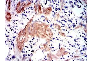 Immunohistochemical analysis of paraffin-embedded stomach cancer tissues using GSTM1 mouse mAb with DAB staining. (GSTM1 antibody)